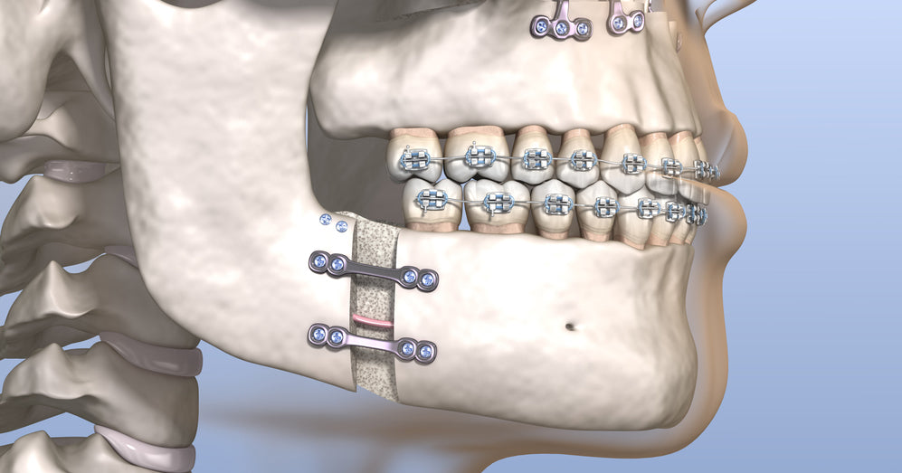 micrognathia jaw