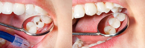 cavities in teeth