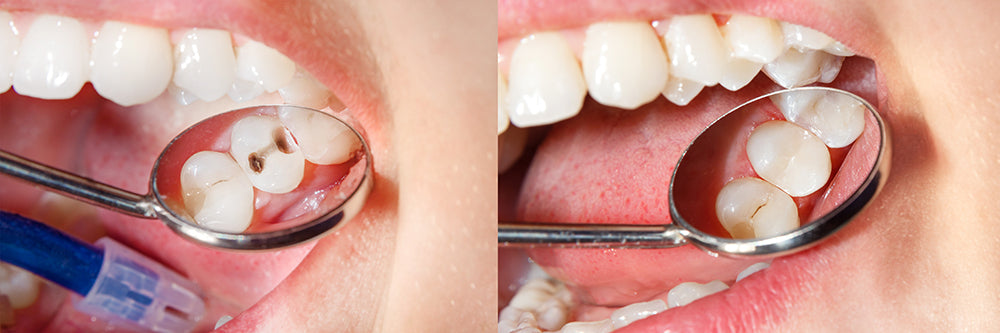 cavities in teeth